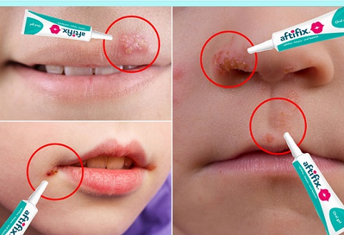 Aftifix gel oral, 15g, Look Ahead - imagine 3